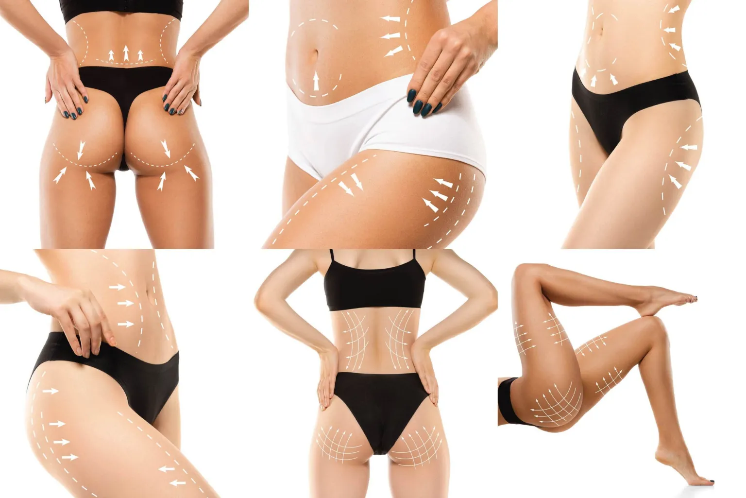 Liposana3+-cropped-bigstock-Cellulite-Removal-Plan-The-Bl-386194987-min-2-scaled-1